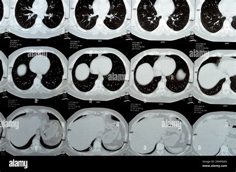 the villages lung ct scan|Computed Tomography (CT) Scan of the Chest .